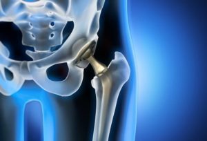 Have You Experienced Complications With Your Stryker Hip Replacement?