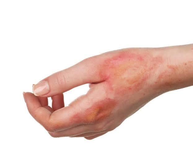 Pressure Cooker Injuries