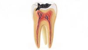 illustration-showing-tooth-decay