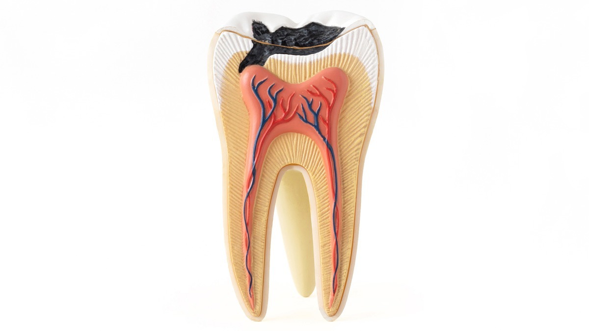 What You Need To Know About Filing A Suboxone Tooth Decay Lawsuit