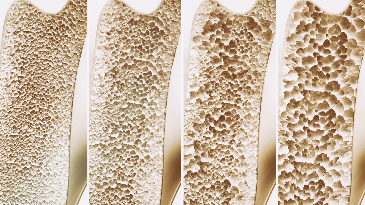 Gilead Truvada (Tenofovir) Lawsuit for Kidney, Bone, & Teeth Injuries
