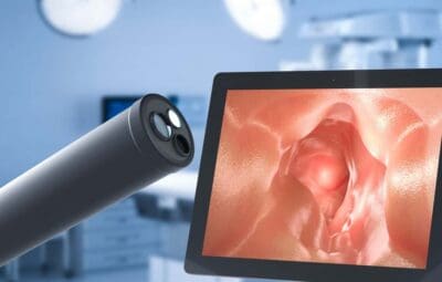 Olympus Endoscope-Related Infections and Lawsuits: What Patients Need to Know