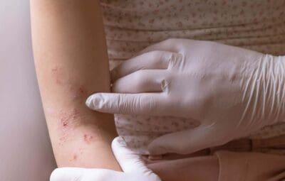 Dupixent Lawsuits and Claims of Cutaneous T-Cell Lymphoma