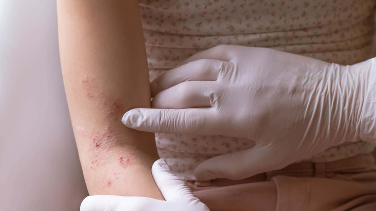 Dupixent Lawsuits and Claims of Cutaneous T-Cell Lymphoma