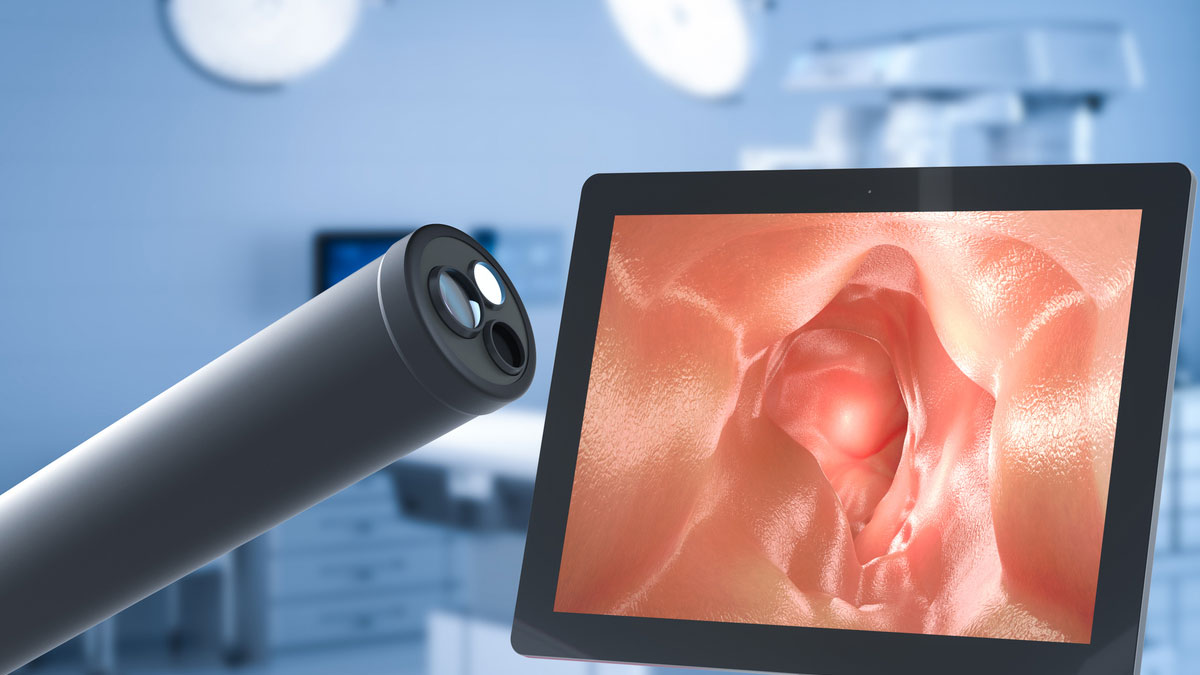 Olympus Endoscope-Related Infections and Lawsuits: What Patients Need to Know