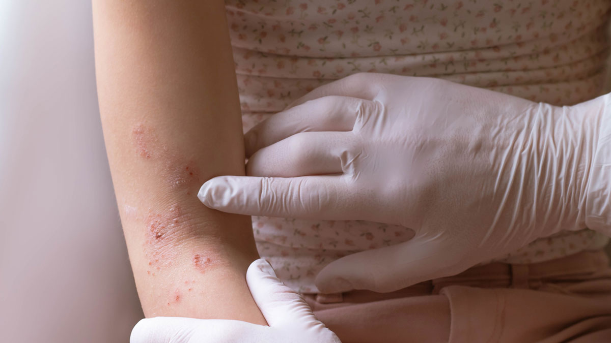 Dupixent Lawsuits and Claims of Cutaneous T-Cell Lymphoma