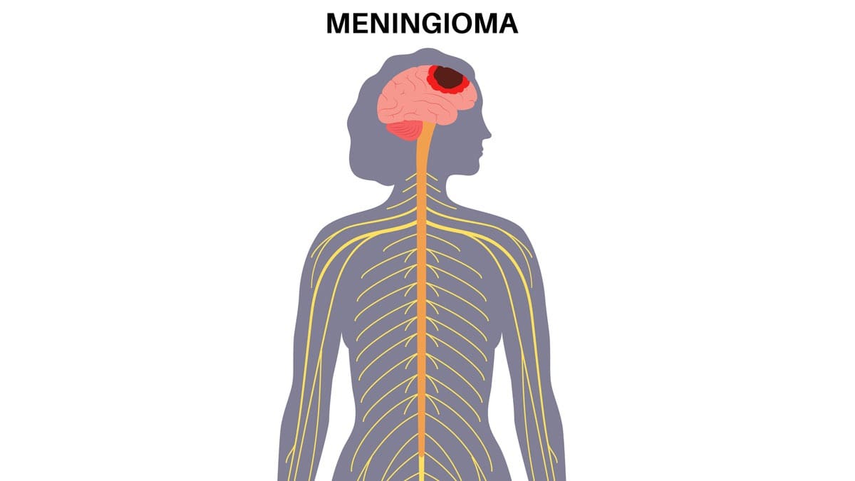 illustration-of-meningioma-in-female