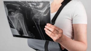 person-in-an-arm-sling-holding-up-an-x-ray-image